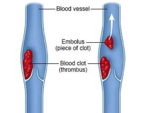 Coding Pulmonary Embolisms and DVTs